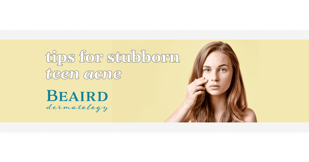 Tips for Stubborn Teen Acne